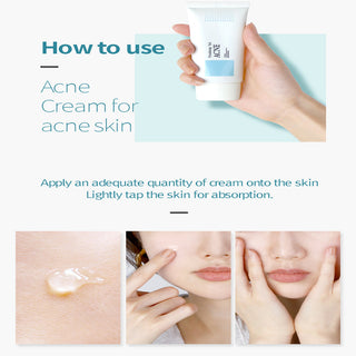 ACNE Cream