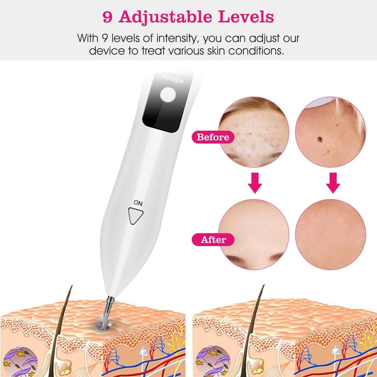 Doba Skin Tag Repair Kit portable beauty device with LCD display, adjustable levels, USB charging, and six replaceable needles for home use.